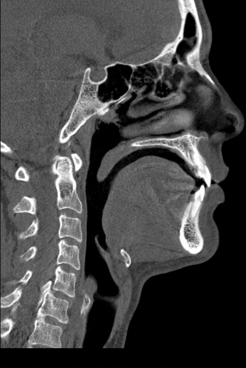 Sagittal CBCT av svelg og luftvei